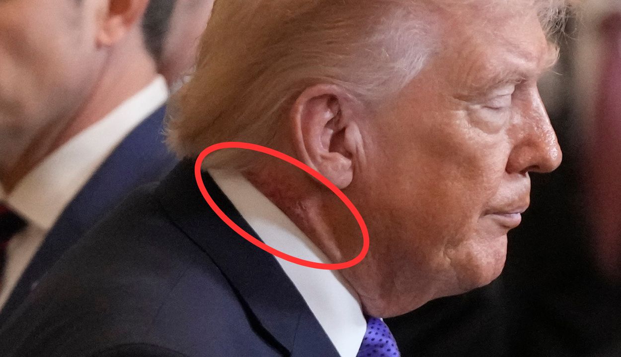 Trump Critics Go Wild Over Pic of New Rash: ‘Vigorous Handshaking Strikes Again!’